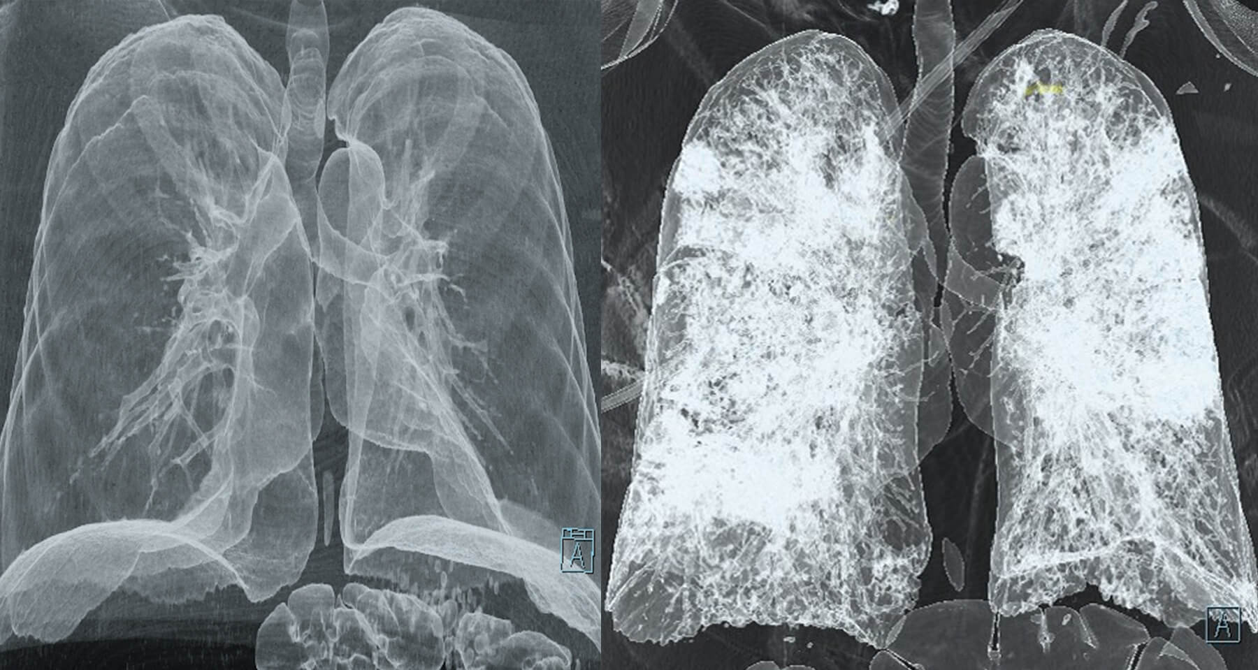 Side-by-side CT scans of lungs. The left hand lungs are healthy, the right hand lungs have covid-19 and show a cloudy overlay.