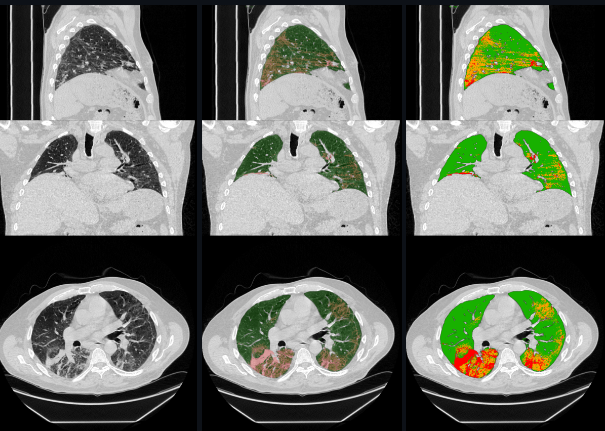 Three sample slices of lung CT scans.