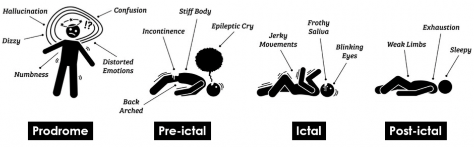 Figure 1 illustrates the four stages of a seizure episode–prodome, pre-ictal, ictal, and post-ictal–along with the symptoms that occur during each stage.
